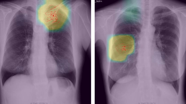 京都府の肺がん検診にPreferred Networks開発の胸部X線画像診断補助ツールを試験導入